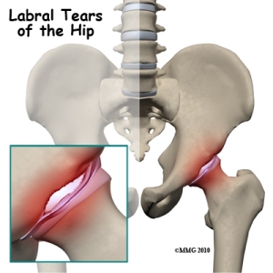 Labral tear of hip